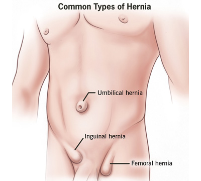 Hernia surgery doctors in Hyderabad Illustration of the abdomen for the awareness of the patients by hernia surgery doctors in Hyderabad
