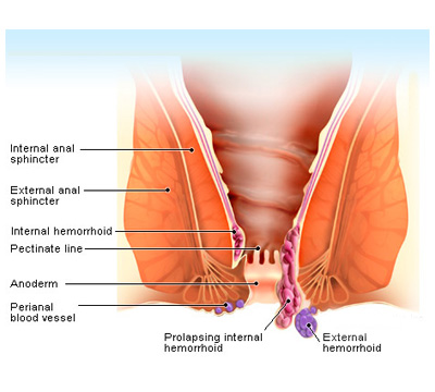 Hemorrhoids Surgery Specialist in Hyderabad Illustration of how hemorrhoids affect for the awareness of patients by hemorrhoids surgery specialist in Hyderabad